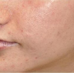 Excel V - Cutera Before & After Patient #1663